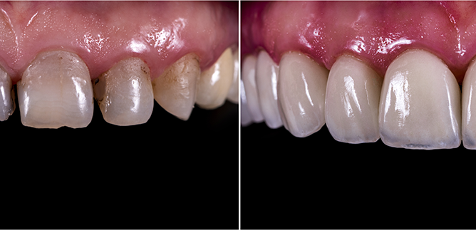 Adhesive Dental Bridges Before and After Image