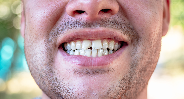 Chipped Tooth Treatment and Care Chelsea