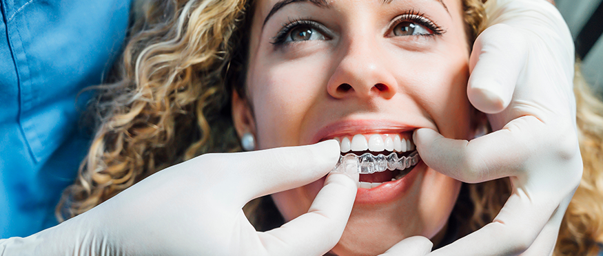 Cost of Invisalign Clear Aligners