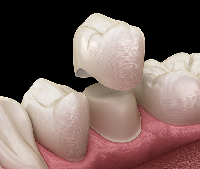 Dental Crowns Care After Treatment in Chelsea