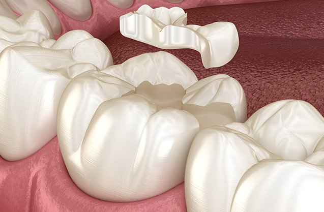 Dental Inlays Onlays Treatment in Chelsea