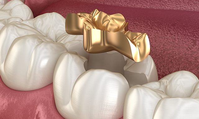 Differences Between Dental Inlays and Onlays