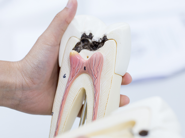 Emergency Root Canal Treatment in Chelsea