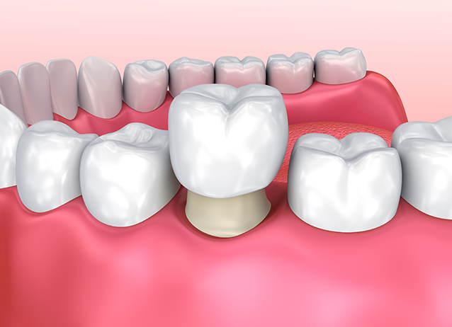 Fixed Dental Crown in London