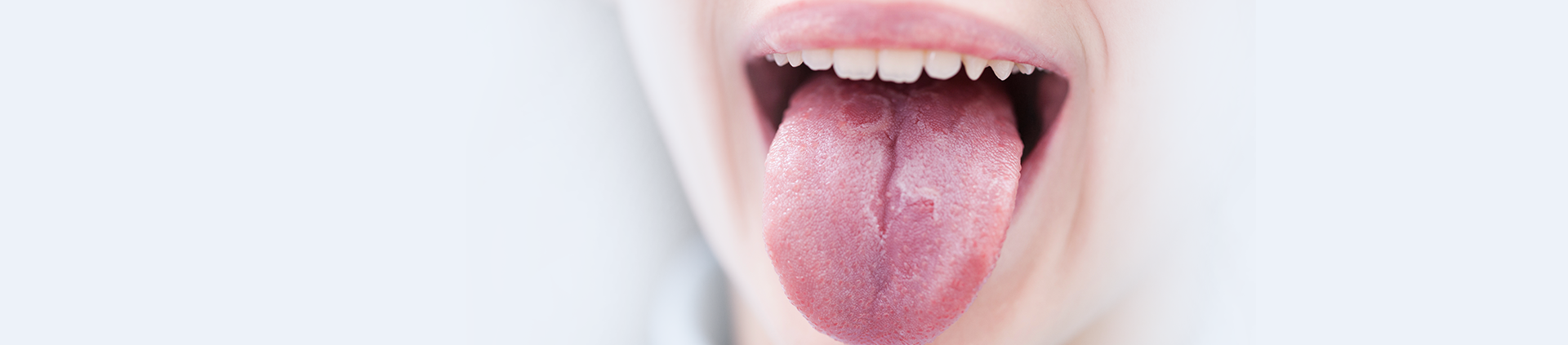 Geographic Tongue Chelsea Banner Image