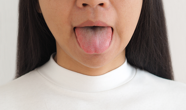 Geographic Tongue Symptoms and Risk Chelsea