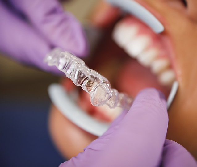 Invisalign Comprehensive Treatment Cost London