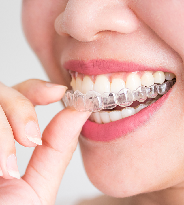 Invisalign I7 Treatment Chelsea London