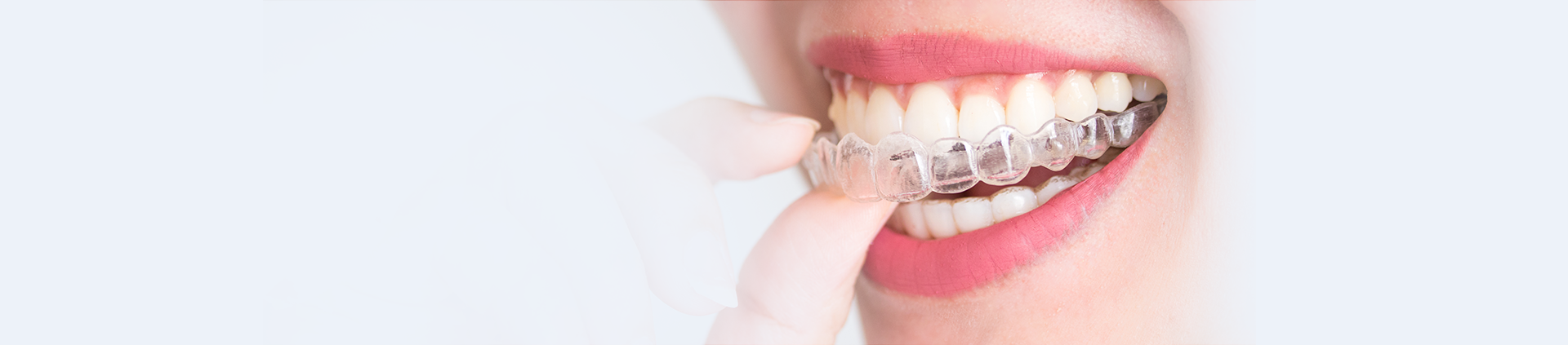 Invisalign Provider London Banner Chelsea 