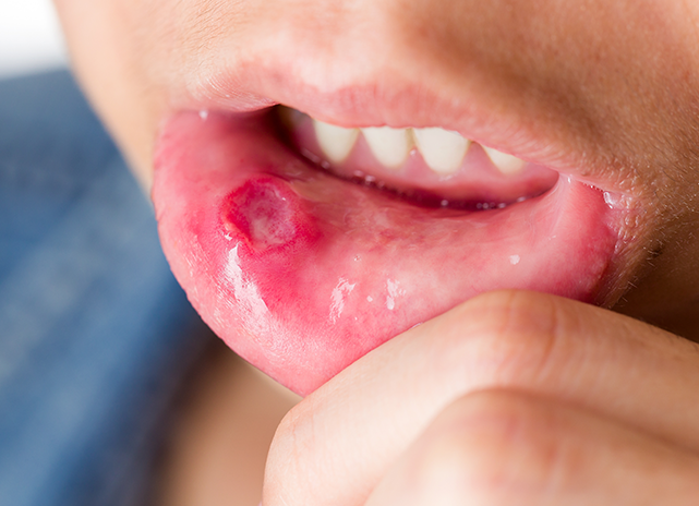 Mouth Sores Diagnosis and Treatment Chelsea, London