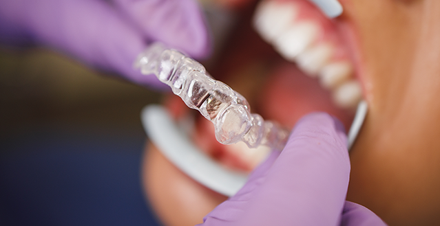 Offers Invisalign Lite London 