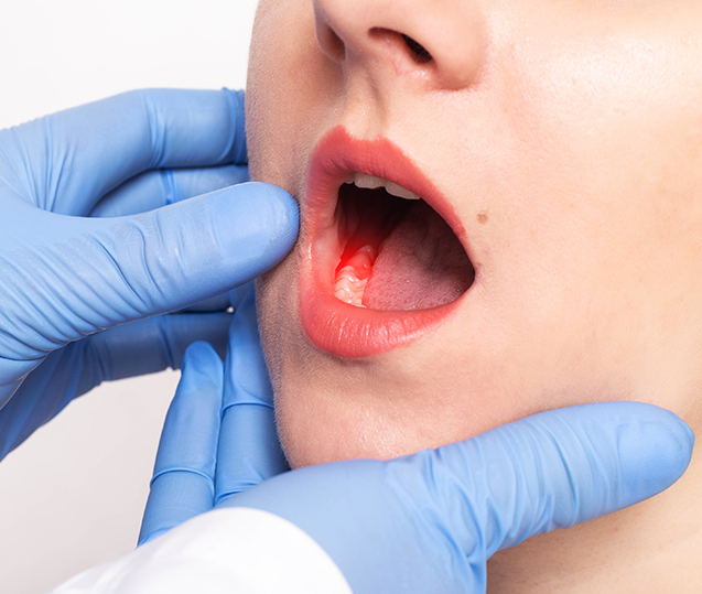 Tooth Abscess Diagnosis and Treatment Chelsea